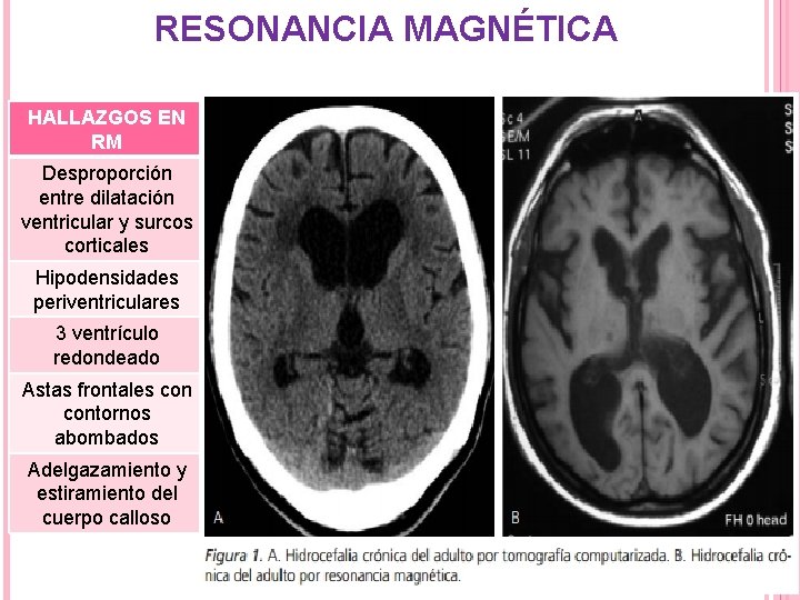 RESONANCIA MAGNÉTICA HALLAZGOS EN RM Desproporción entre dilatación ventricular y surcos corticales Hipodensidades periventriculares