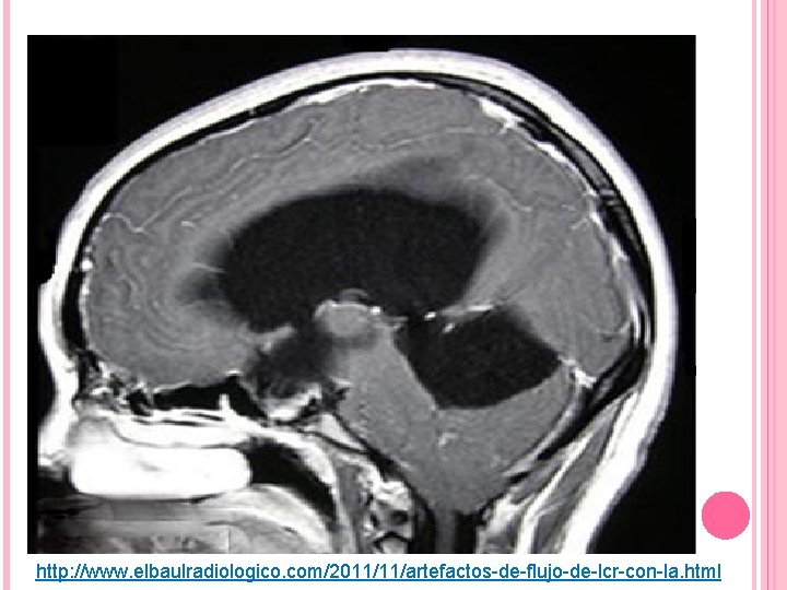 http: //www. elbaulradiologico. com/2011/11/artefactos-de-flujo-de-lcr-con-la. html 