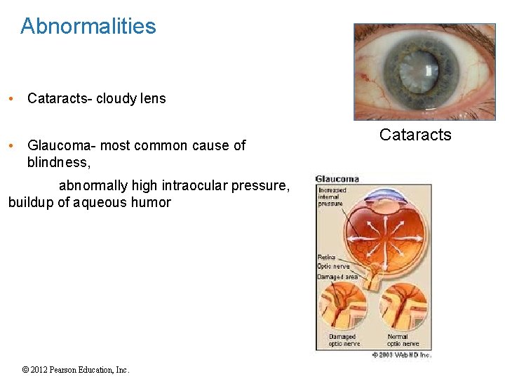 Abnormalities • Cataracts- cloudy lens • Glaucoma- most common cause of blindness, abnormally high Abnormalities • Cataracts- cloudy lens • Glaucoma- most common cause of blindness, abnormally high