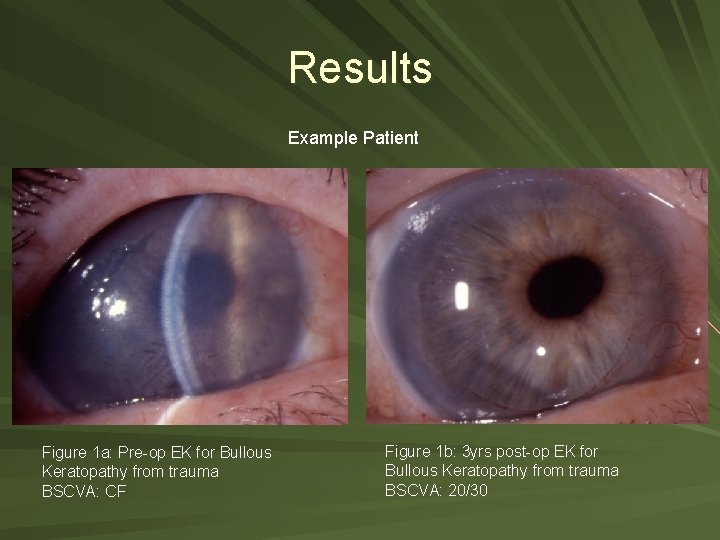 Results Example Patient Figure 1 a: Pre-op EK for Bullous Keratopathy from trauma BSCVA: