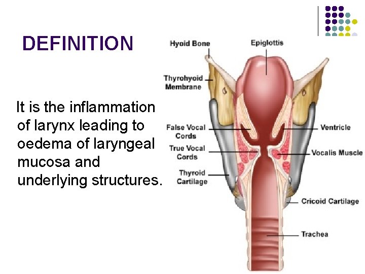 DEFINITION It is the inflammation of larynx leading to oedema of laryngeal mucosa and