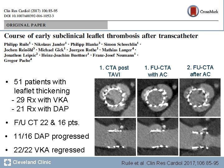  • 51 patients with leaflet thickening - 29 Rx with VKA - 21