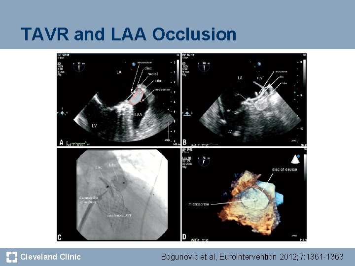 TAVR and LAA Occlusion Cleveland Clinic Bogunovic et al, Euro. Intervention 2012; 7: 1361
