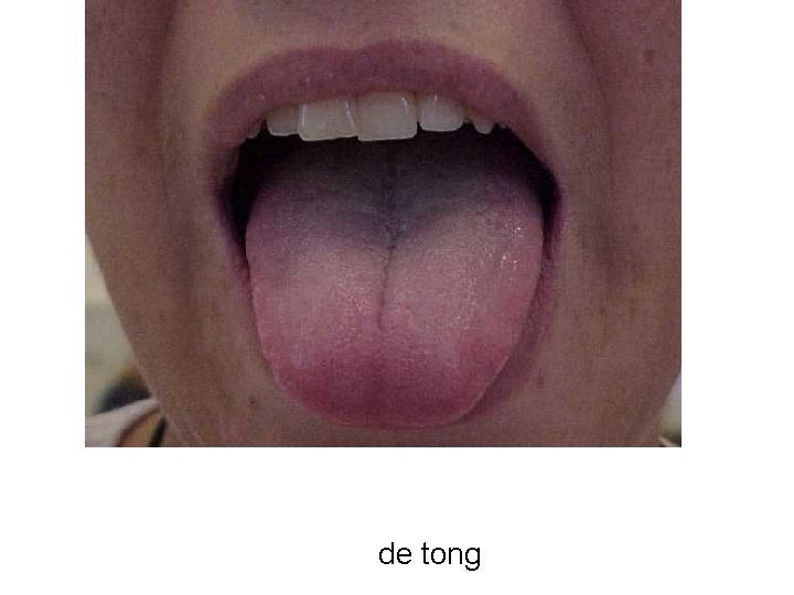 de tong 