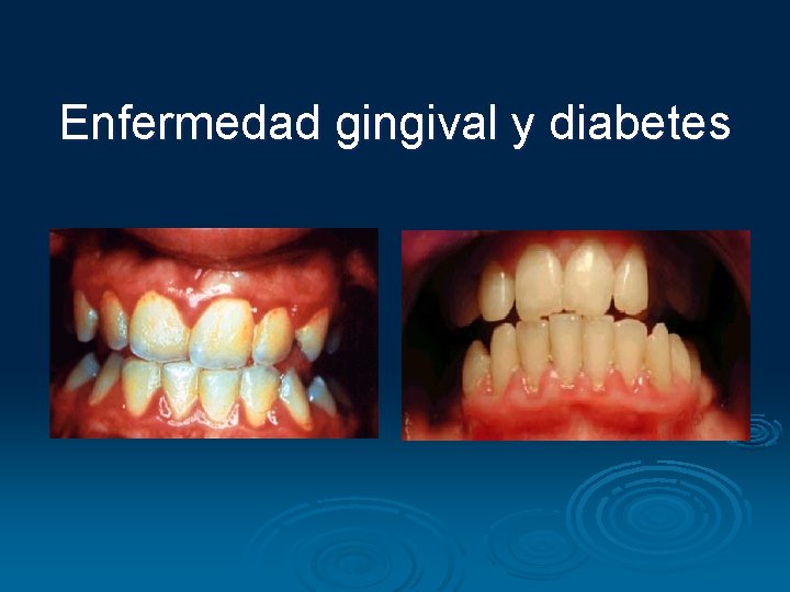 Enfermedad gingival y diabetes 