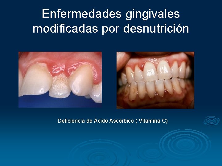 Enfermedades gingivales modificadas por desnutrición Deficiencia de Ácido Ascórbico ( Vitamina C) 