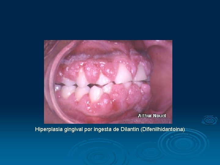 Hiperplasia gingival por ingesta de Dilantin (Difenilhidantoina) 