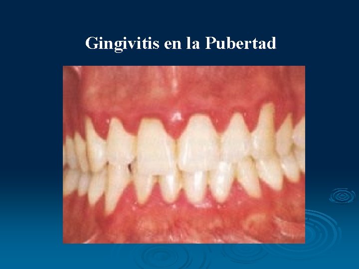 Gingivitis en la Pubertad 