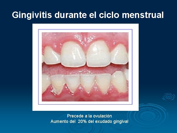 Gingivitis durante el ciclo menstrual Precede a la ovulación Aumento del 20% del exudado