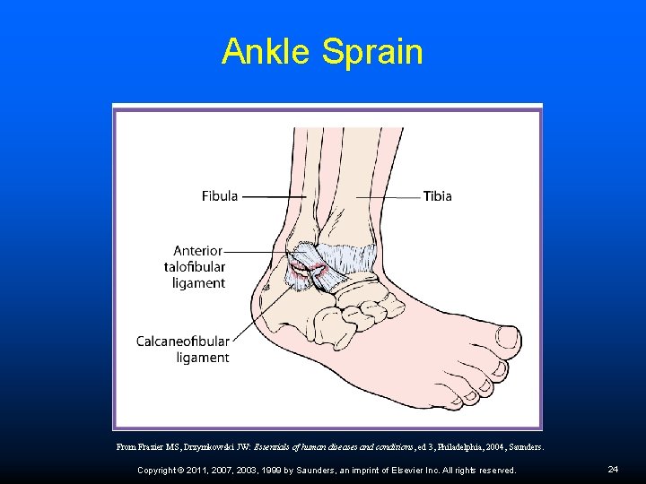 Ankle Sprain From Frazier MS, Drzymkowski JW: Essentials of human diseases and conditions, ed