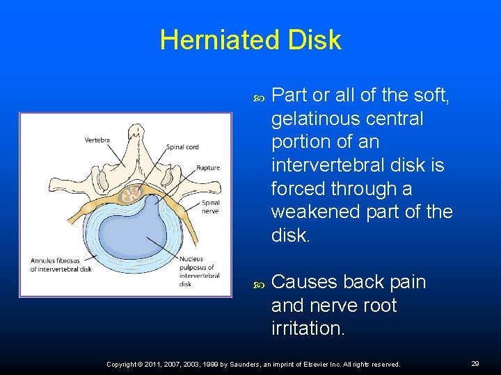 Herniated Disk Part or all of the soft, gelatinous central portion of an intervertebral