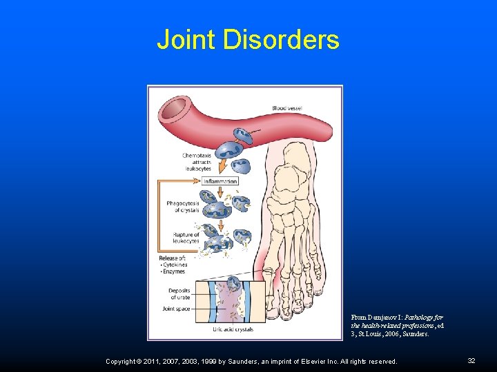 Joint Disorders From Damjanov I: Pathology for the health-related professions, ed 3, St Louis,