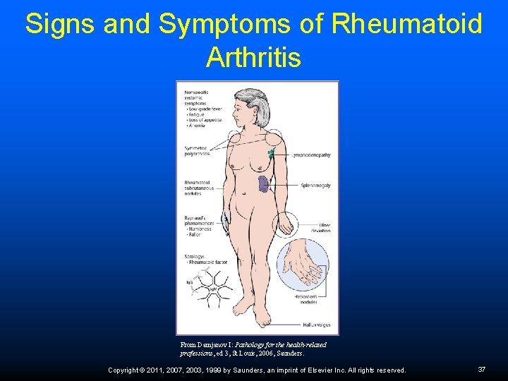 Signs and Symptoms of Rheumatoid Arthritis From Damjanov I: Pathology for the health-related professions,