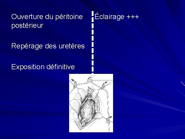 Ouverture du péritoine postérieur Repérage des uretères Exposition définitive Éclairage +++ 