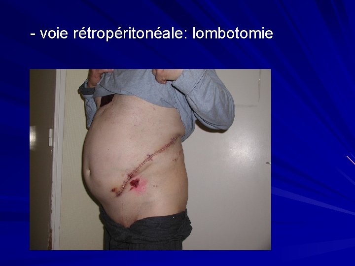 - voie rétropéritonéale: lombotomie 