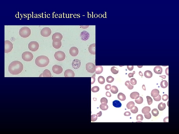 dysplastic features - blood 