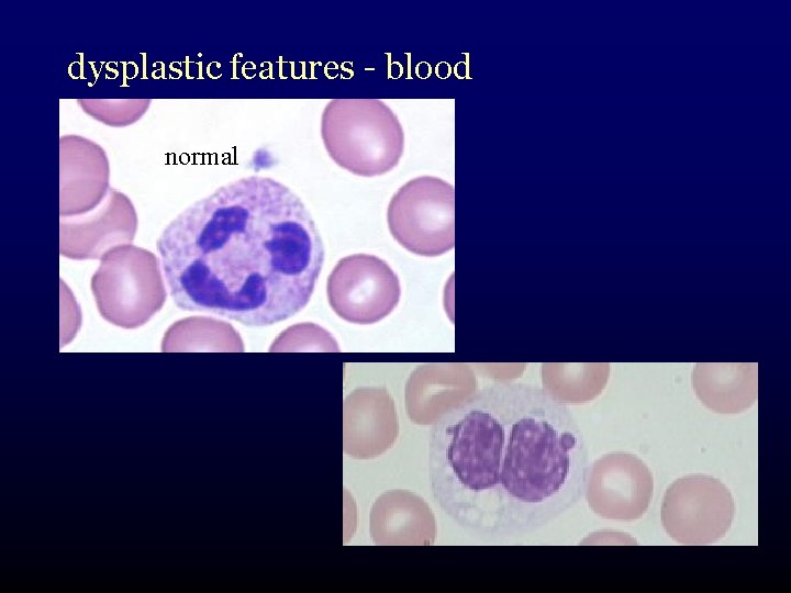 dysplastic features - blood normal 