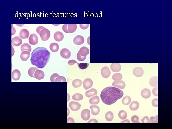 dysplastic features - blood 