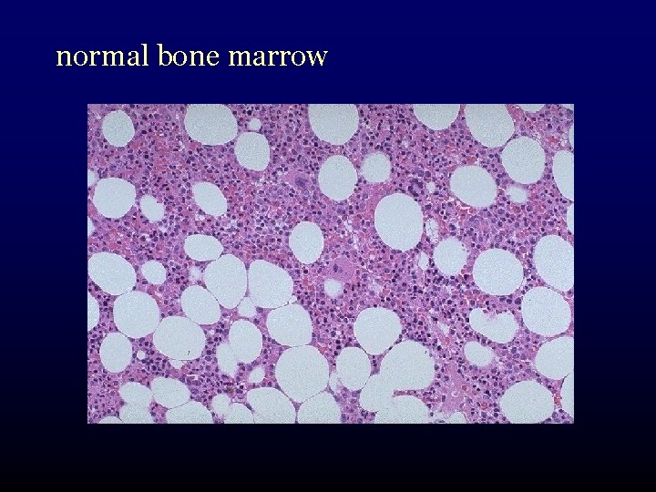 normal bone marrow 