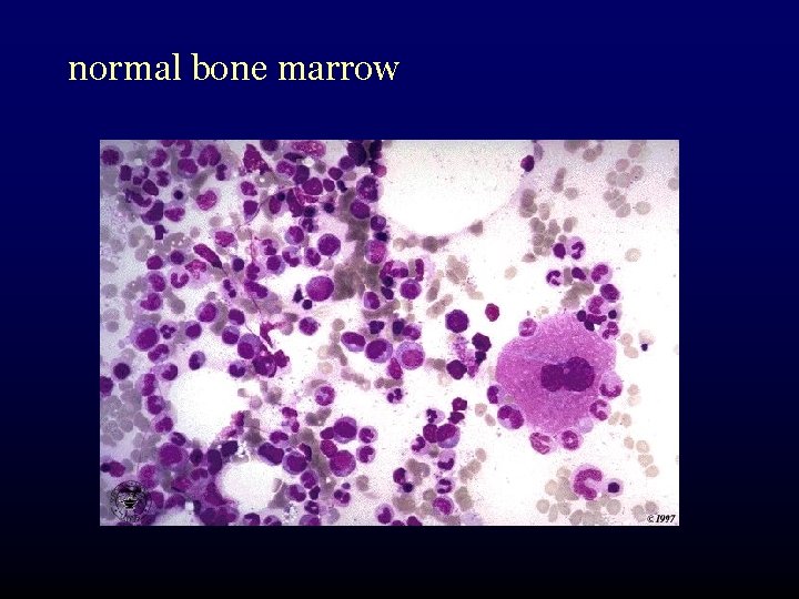 normal bone marrow 