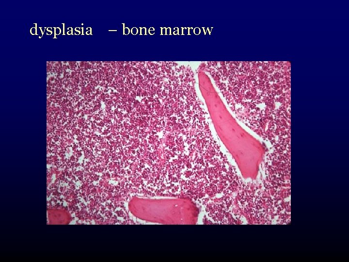 dysplasia – bone marrow 