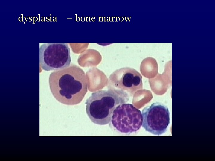 dysplasia – bone marrow 