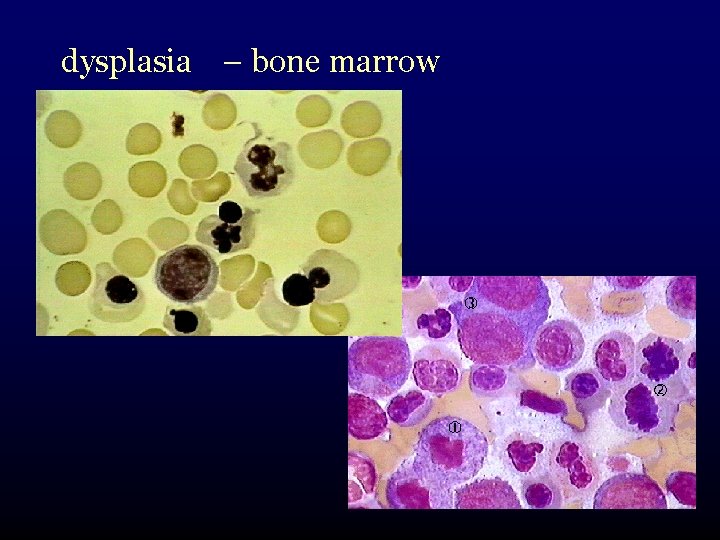 dysplasia – bone marrow 