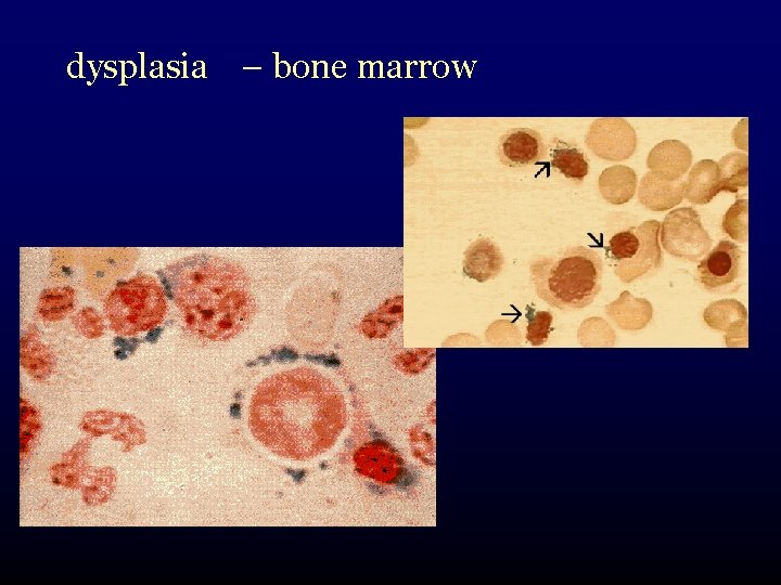 dysplasia – bone marrow 