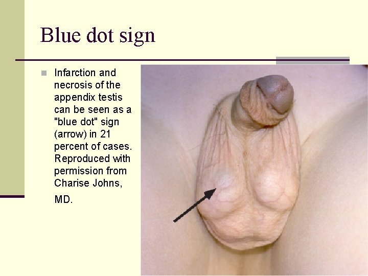 Blue dot sign n Infarction and necrosis of the appendix testis can be seen