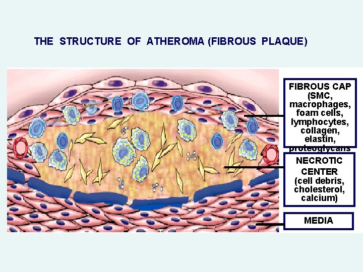 THE STRUCTURE OF ATHEROMA (FIBROUS PLAQUE) FIBROUS CAP (SMC, macrophages, foam cells, lymphocytes, collagen,