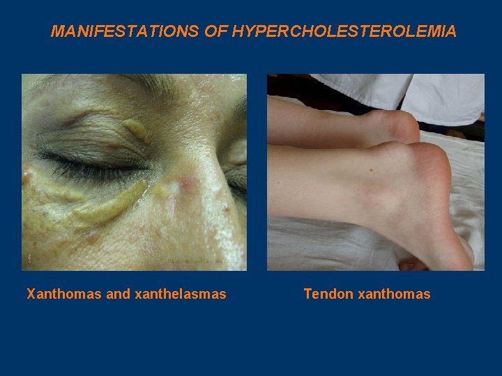 MANIFESTATIONS OF HYPERCHOLESTEROLEMIA Xanthomas and xanthelasmas Tendon xanthomas 
