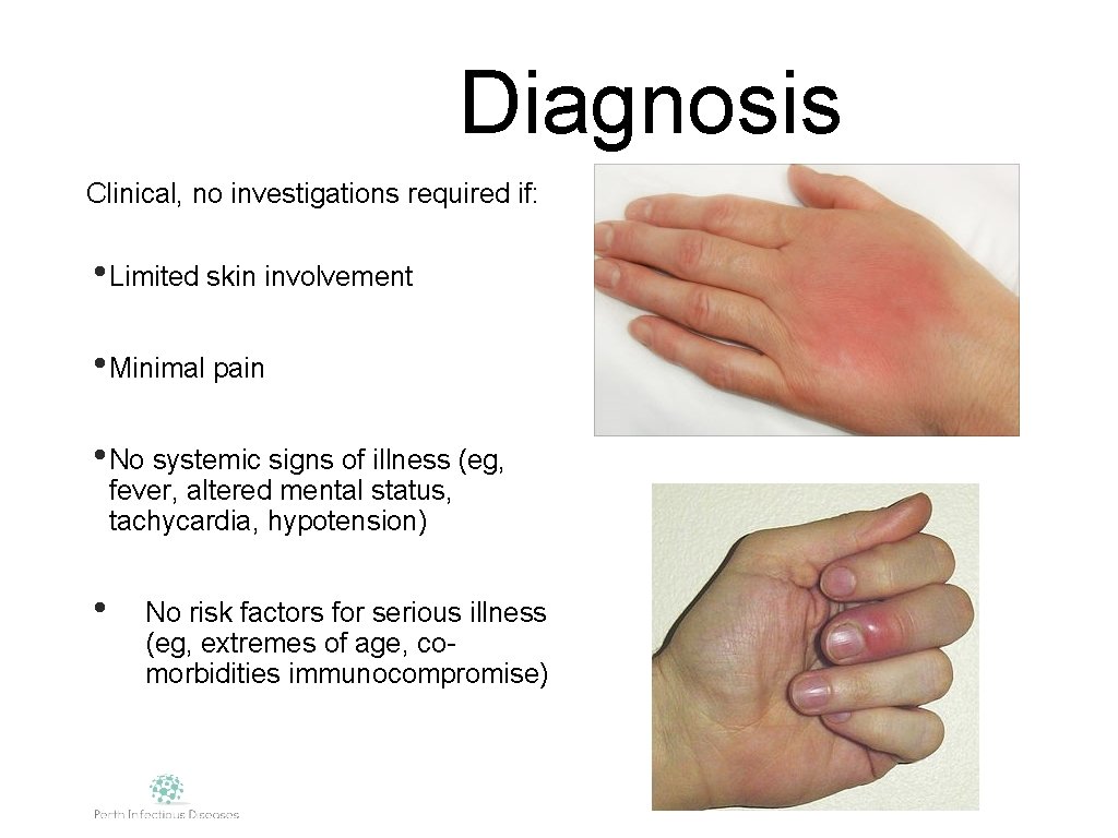 Diagnosis Clinical, no investigations required if: • Limited skin involvement • Minimal pain •
