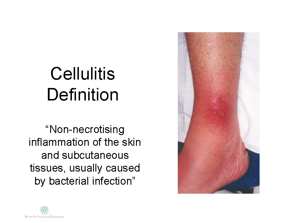 Cellulitis Definition “Non-necrotising inflammation of the skin and subcutaneous tissues, usually caused by bacterial