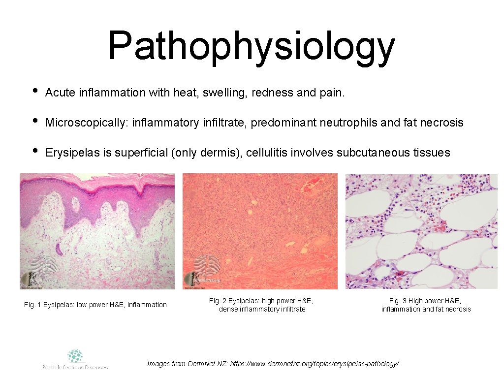 Pathophysiology • Acute inflammation with heat, swelling, redness and pain. • Microscopically: inflammatory infiltrate,