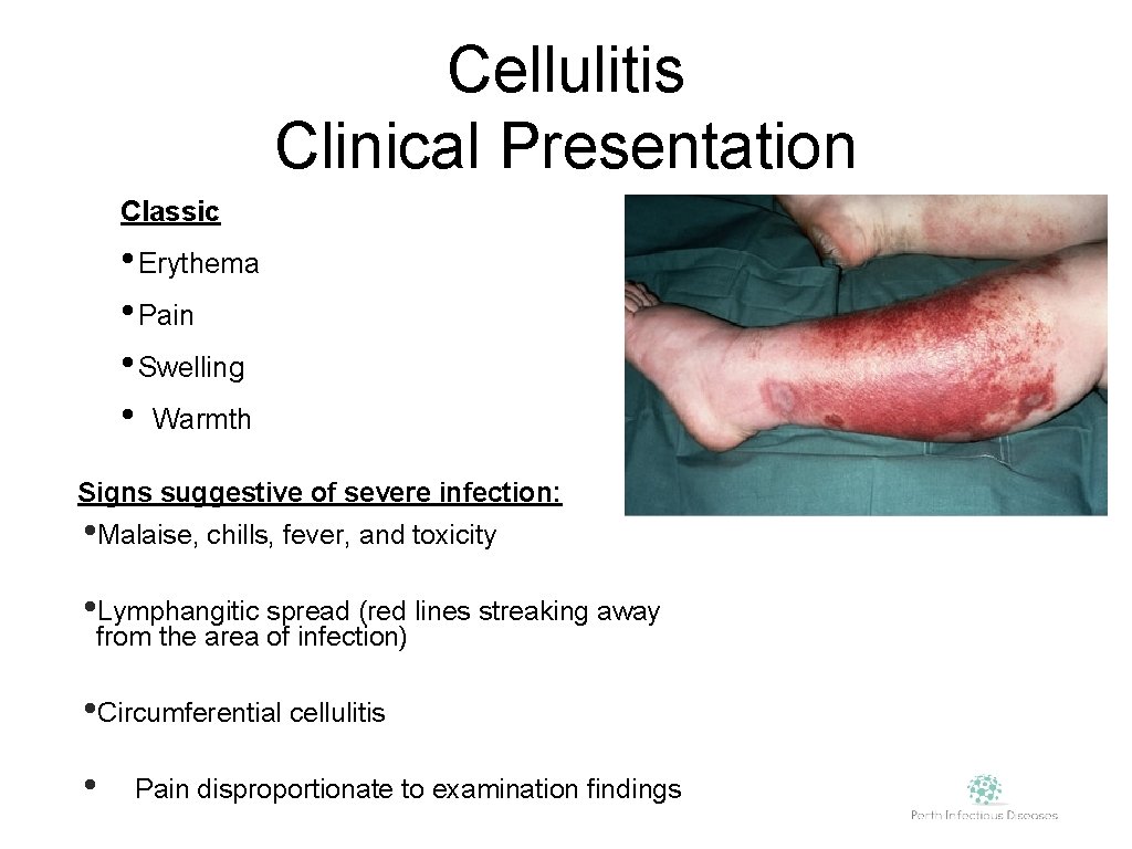 Cellulitis Clinical Presentation Classic • Erythema • Pain • Swelling • Warmth Signs suggestive