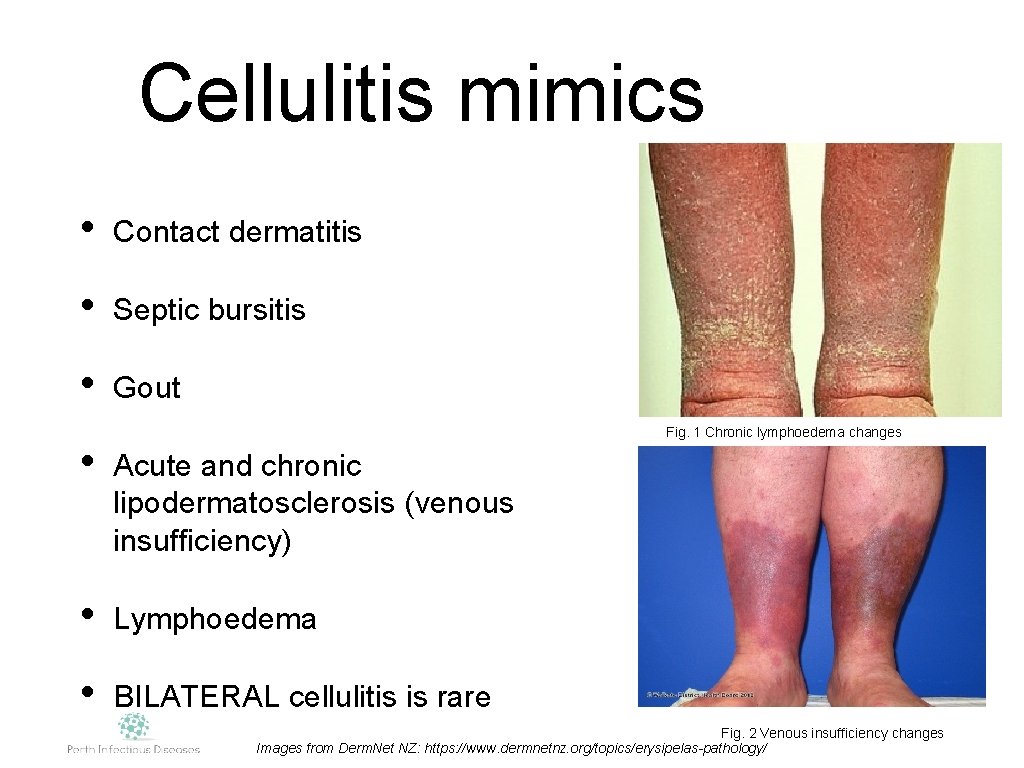 Cellulitis mimics • Contact dermatitis • Septic bursitis • Gout Fig. 1 Chronic lymphoedema