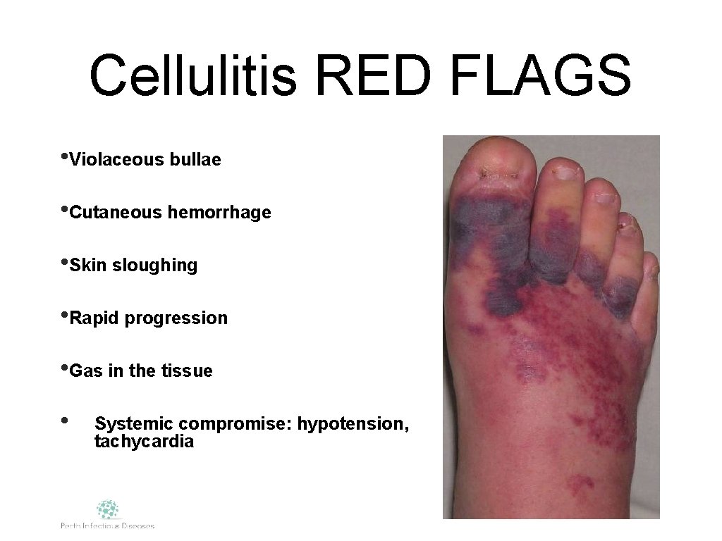 Cellulitis RED FLAGS • Violaceous bullae • Cutaneous hemorrhage • Skin sloughing • Rapid