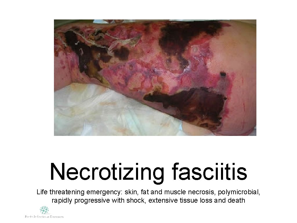 Necrotizing fasciitis Life threatening emergency: skin, fat and muscle necrosis, polymicrobial, rapidly progressive with