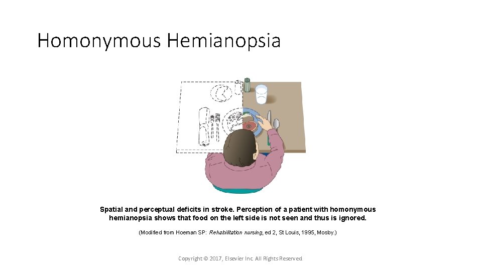 Homonymous Hemianopsia Spatial and perceptual deficits in stroke. Perception of a patient with homonymous