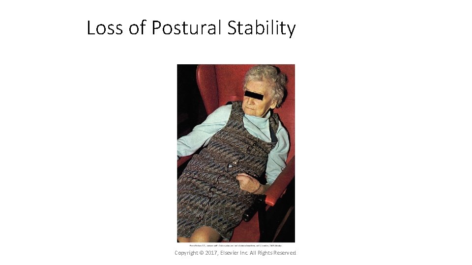 Loss of Postural Stability Copyright © 2017, Elsevier Inc. All Rights Reserved. 