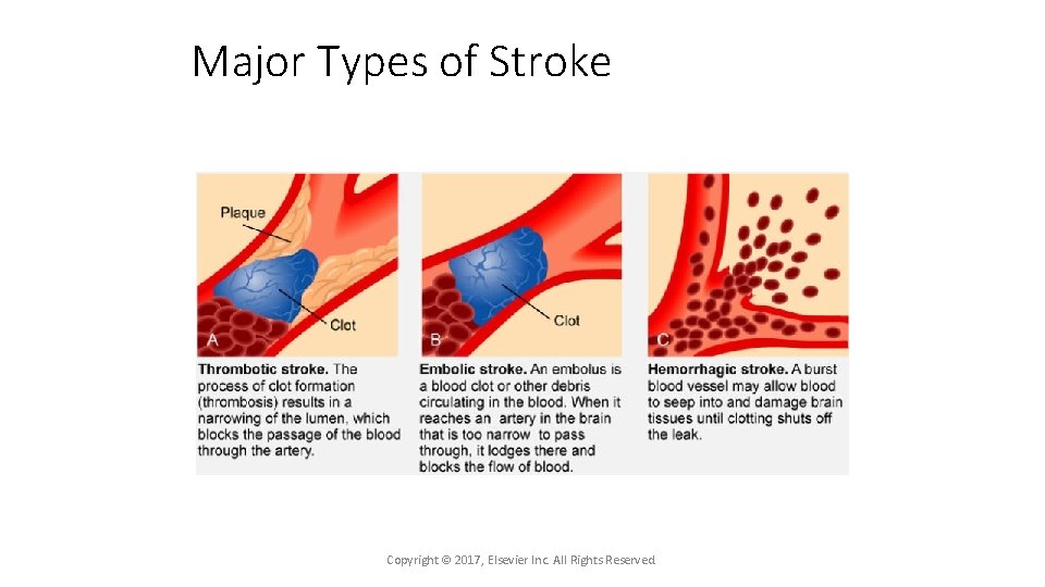 Major Types of Stroke Copyright © 2017, Elsevier Inc. All Rights Reserved. 