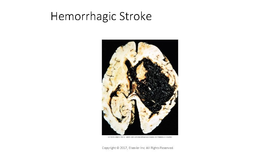 Hemorrhagic Stroke Copyright © 2017, Elsevier Inc. All Rights Reserved. 