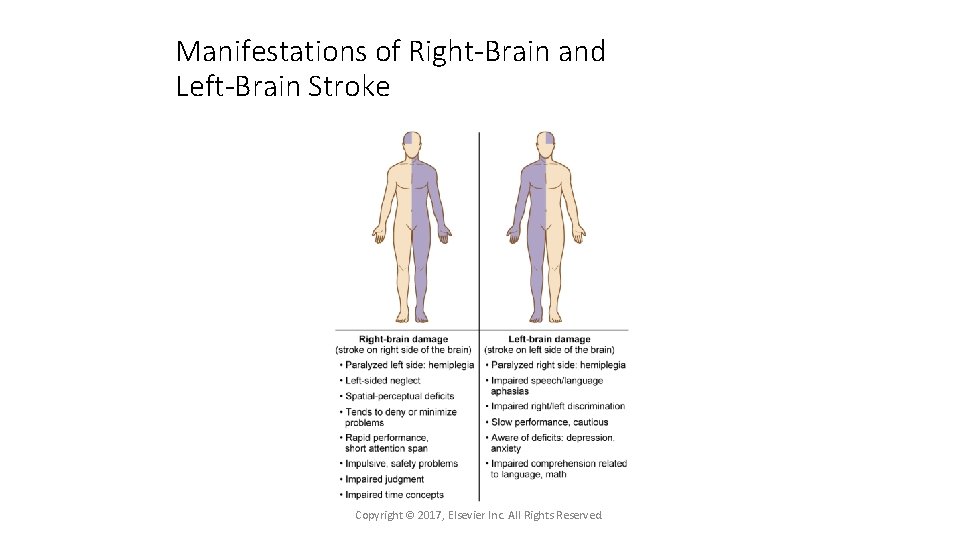 Manifestations of Right-Brain and Left-Brain Stroke Copyright © 2017, Elsevier Inc. All Rights Reserved.