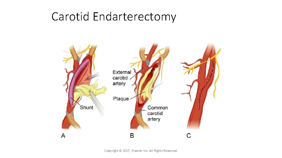 Carotid Endarterectomy Copyright © 2017, Elsevier Inc. All Rights Reserved. 