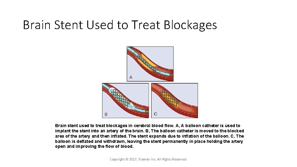 Brain Stent Used to Treat Blockages Brain stent used to treat blockages in cerebral