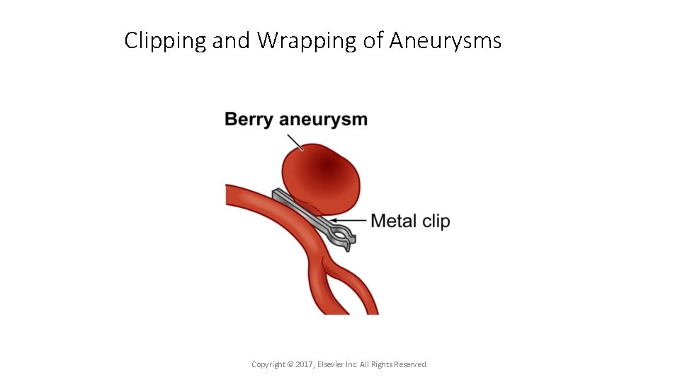 Clipping and Wrapping of Aneurysms Copyright © 2017, Elsevier Inc. All Rights Reserved. 