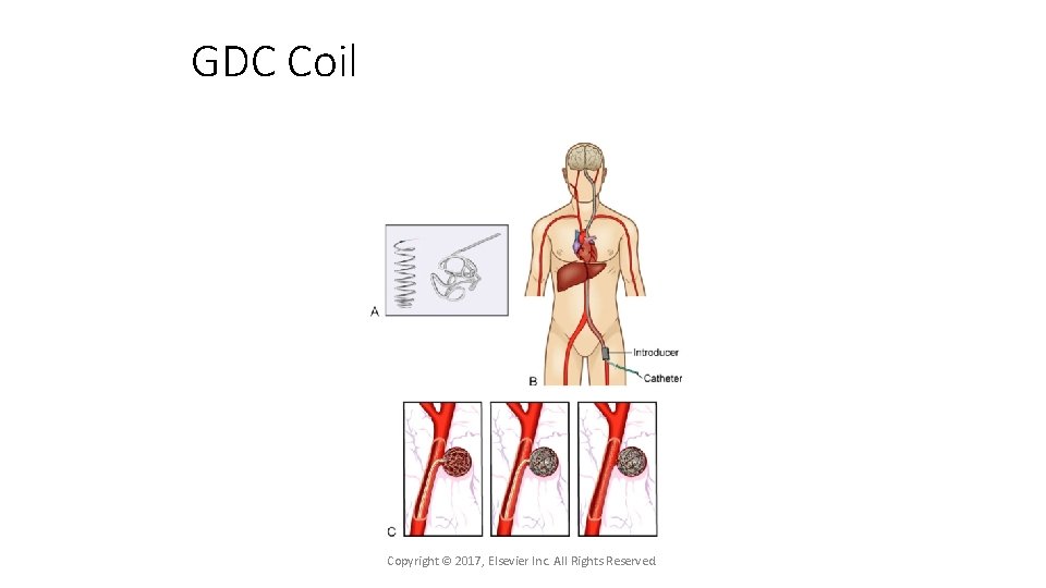 GDC Coil Copyright © 2017, Elsevier Inc. All Rights Reserved. 