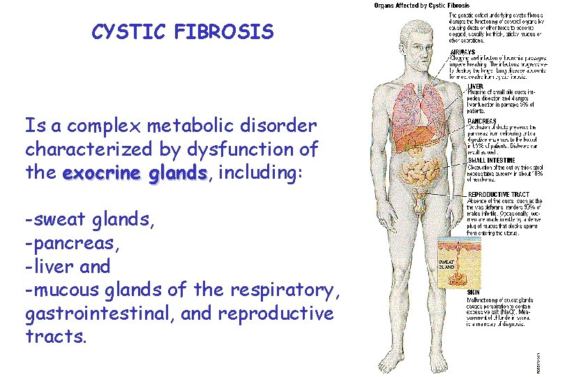 CYSTIC FIBROSIS Is a complex metabolic disorder characterized by dysfunction of the exocrine glands,