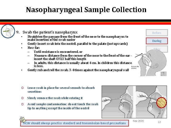 Nasopharyngeal Sample Collection 9. Swab the patient’s nasopharynx Before Straighten the passage from the Nasopharyngeal Sample Collection 9. Swab the patient’s nasopharynx Before Straighten the passage from the