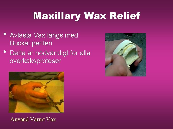 Maxillary Wax Relief • Avlasta Vax längs med • Buckal periferi Detta är nödvändigt